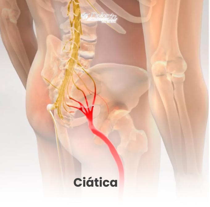 quiropractico-monterrey-cita-ciatica